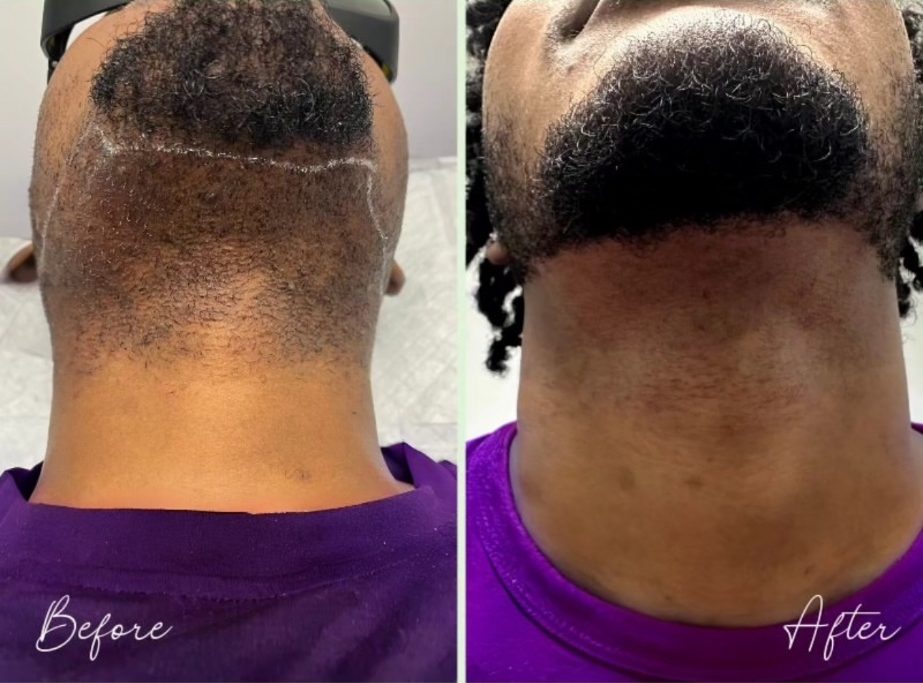 Neck below the beard line before and after laser hair removal