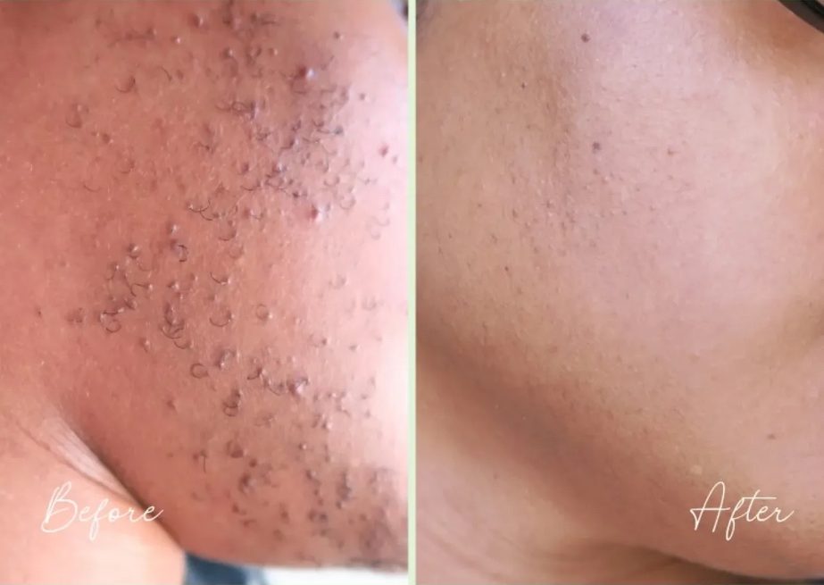 Cheek covered in hair bumps before, and clear smooth skin after