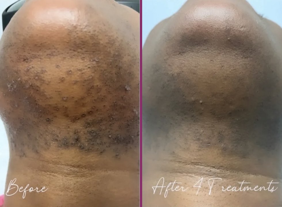 A woman's chin and neck covered in hair bumps before, and smoother skin after 4 laser treatments
