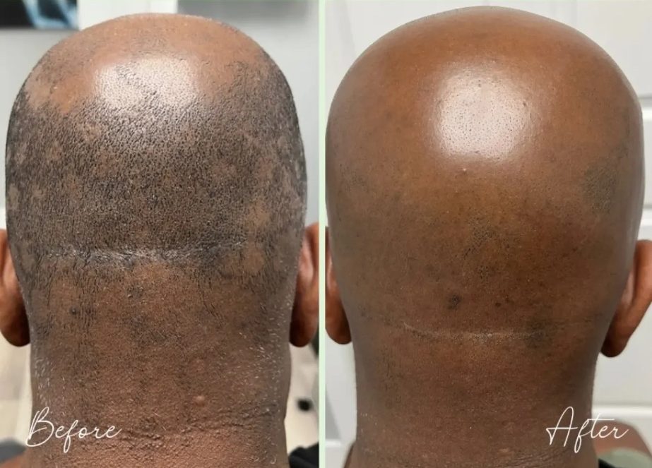 Back of a man's head before and after laser hair removal